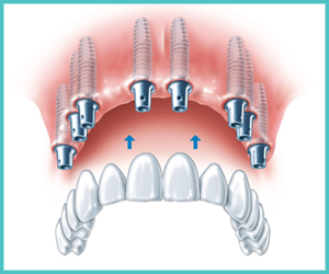 implant supported fixed bridge
