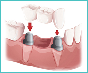 dental crown and bridge treatment