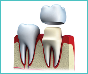Dental Crown or Case