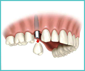 dental crown treatment