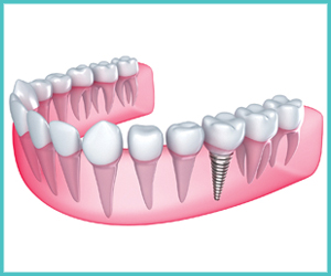 Dental implant